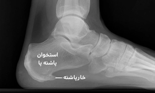 درمان خار پاشنه با کرم کرویا