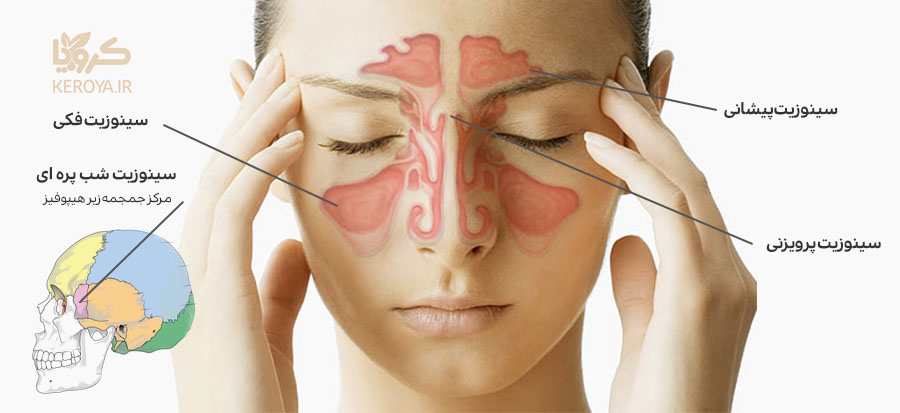 پیشگیری و درمان سینوزیت