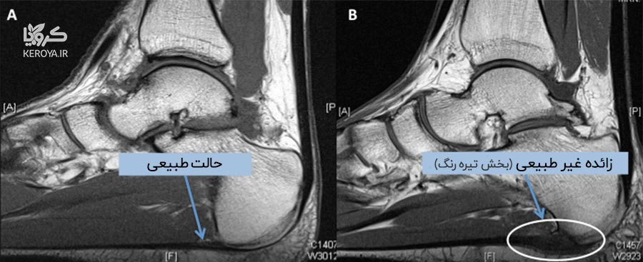 بررسی پلانتار فاشیا و خار پاشنه در طب سنتی [مقاله پژوهشی]